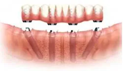 Dental Implants