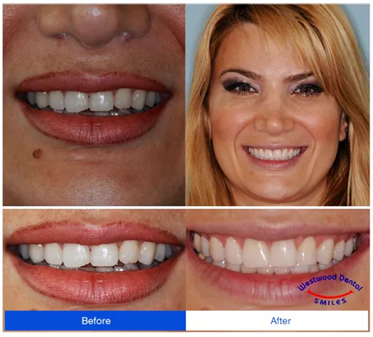 Dental Implant 90024 Westside LA