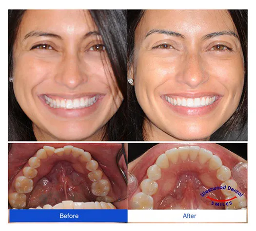 Tooth Emergency 90024 Westside LA