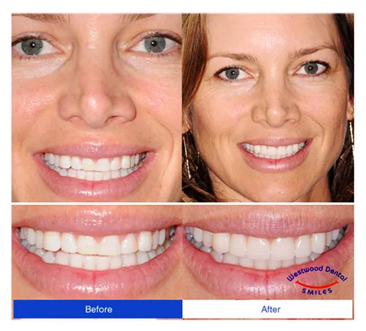 Full Mouth Reconstruction UCLA