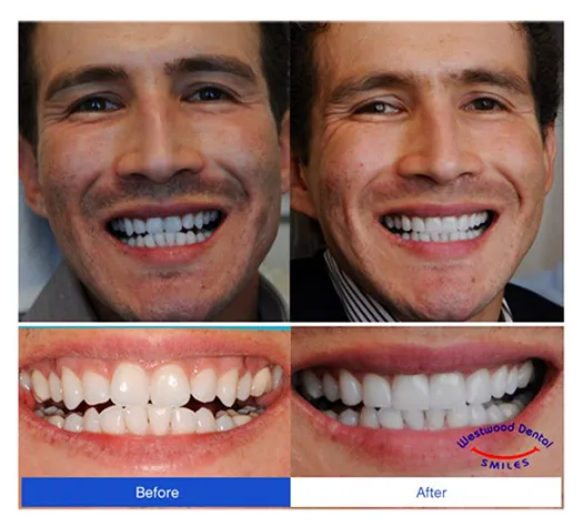 Smile Makeover 90024 Westwood LA