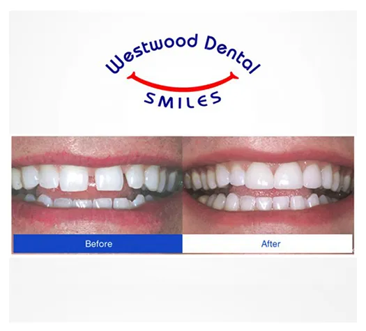 Dental Veneers 90024 Westside LA