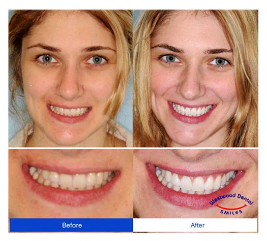 Prothodontist 90024 Westside LA