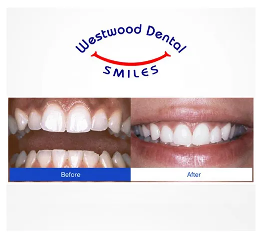 Root Canal 90024 Westside LA